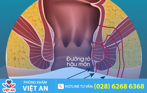 rò hậu môn