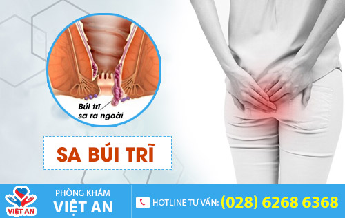 Sa búi trĩ