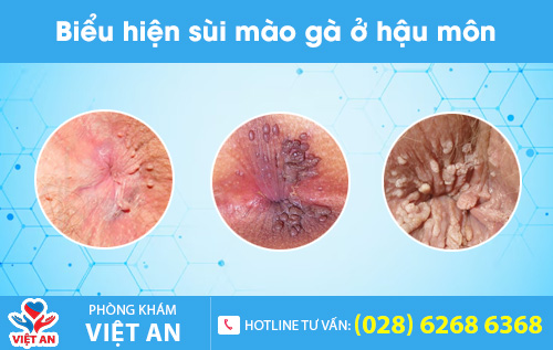 Sùi mào gà ở hậu môn