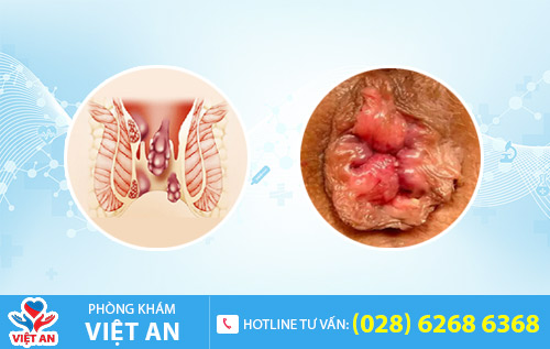 Bệnh trĩ hỗn hợp