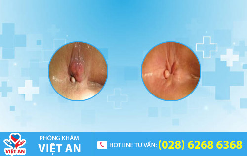 Bệnh trĩ ngoại độ 1