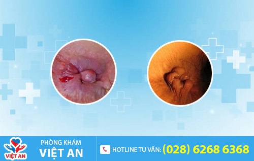 bệnh trĩ ngoại độ 2