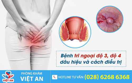 Trĩ ngoại độ 3 độ 4