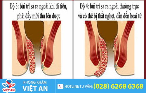Biểu hiện của bệnh trĩ ngoại độ 3, độ 4
