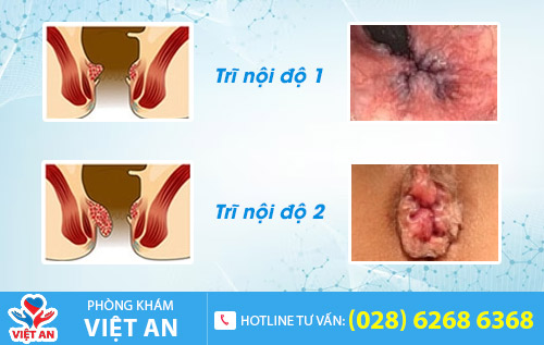 Trĩ nội độ 1, độ 2