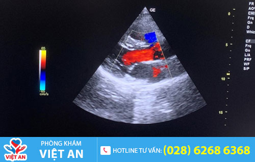 Siêu âm Doppler