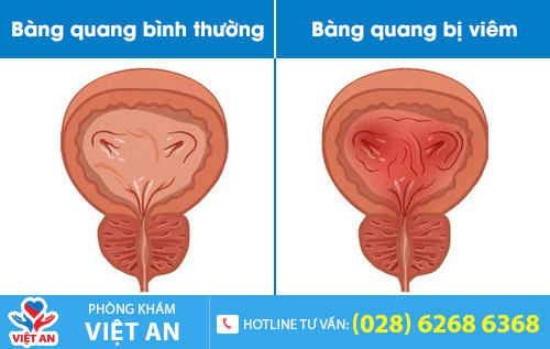 Viêm bàng quang